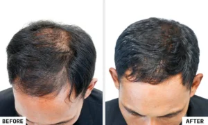 Laser Hair Reduction Treatment in Guwahati at Essence Skin Care
