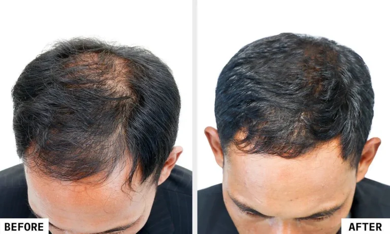 Laser Hair Reduction Treatment in Guwahati at Essence Skin Care