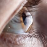 LASIK Eye Surgery London