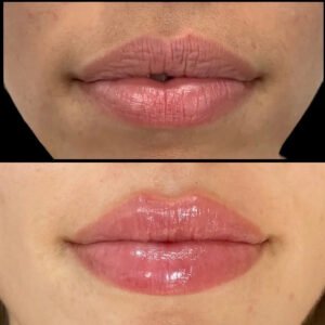 V10-Lip-Fillers