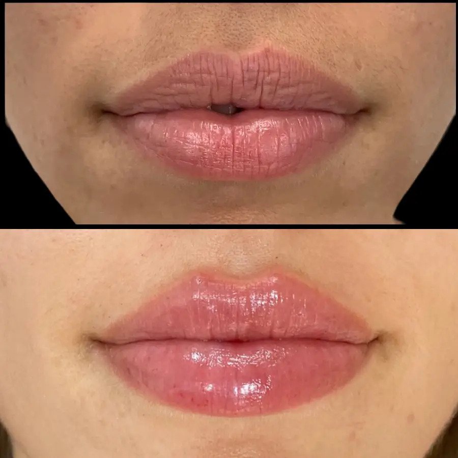 V10-Lip-Fillers