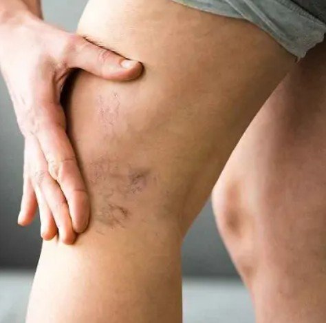 Varicose Veins Treatment In Dubai