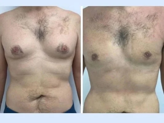 gynecomastia in dubai.