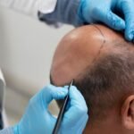 hair transplant