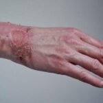 Skin Substitute