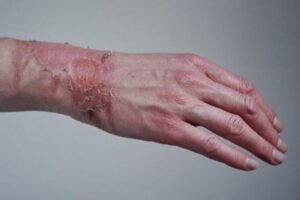 Skin Substitute