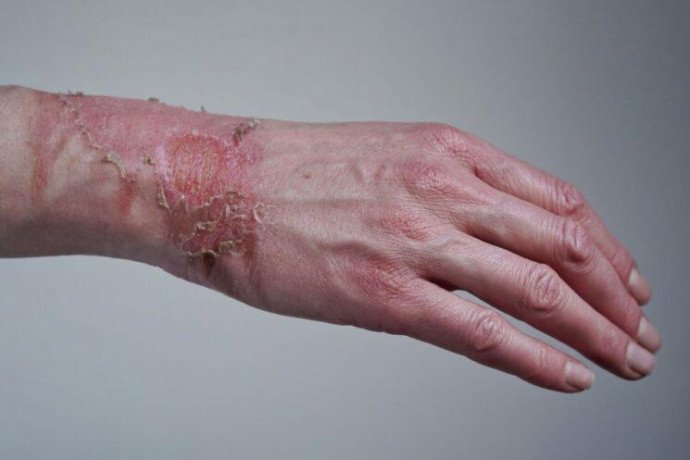 Skin Substitute