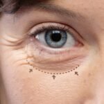 Blepharoplasty-lower-1