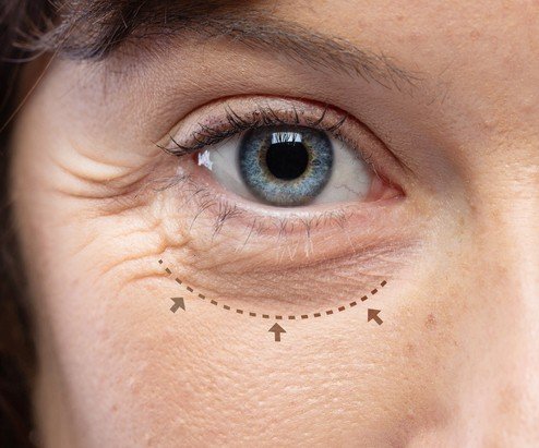 Blepharoplasty-lower-1