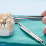 Dental bridges brandon fl
