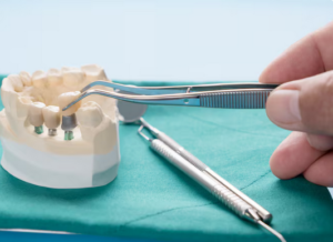 Dental bridges brandon fl
