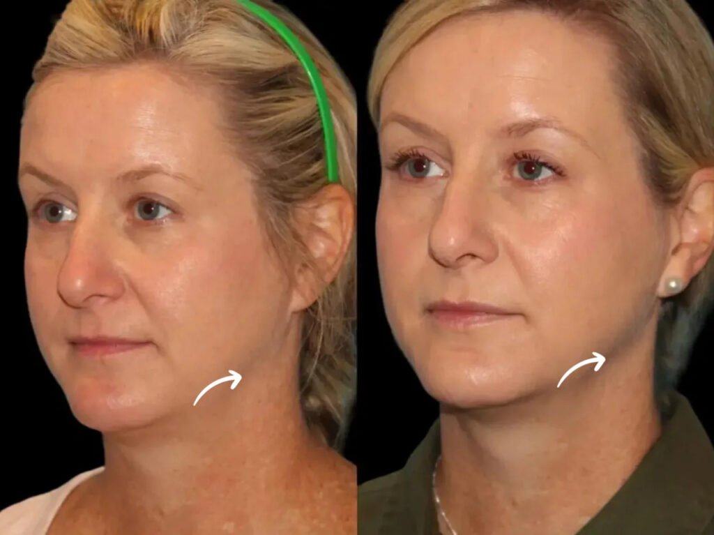 sculptra in dubai