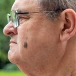 Home Remedies for Seborrheic Keratosis and safe skincare options for common skin growths