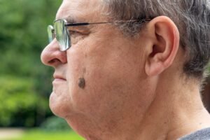 Home Remedies for Seborrheic Keratosis and safe skincare options for common skin growths