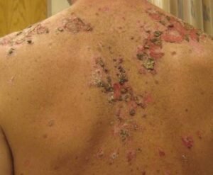 Pemphigus Vulgaris and Nutrition