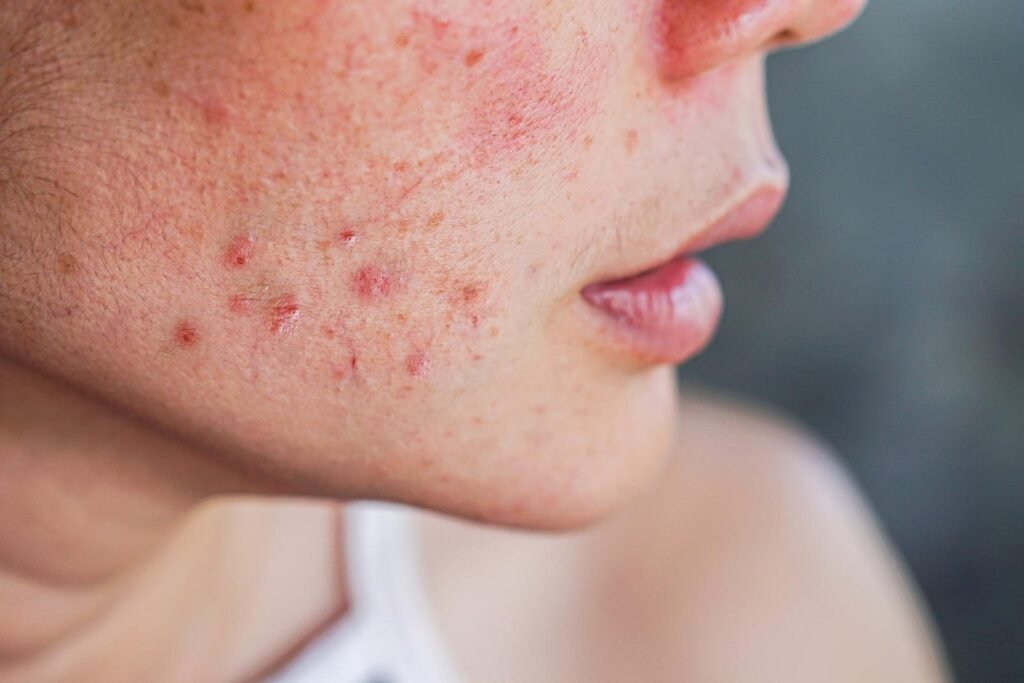 acne-removal-treatment-dubai-1024x683