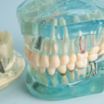 all on 4 dental implants pikeville ky