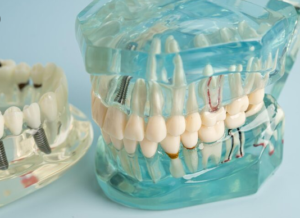 all on 4 dental implants pikeville ky