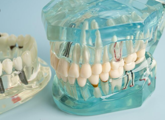 all on 4 dental implants pikeville ky