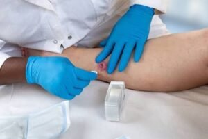 Can You Get Hidradenitis Suppurativa on Your Face? What Research Says