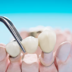 dental bridges madison al