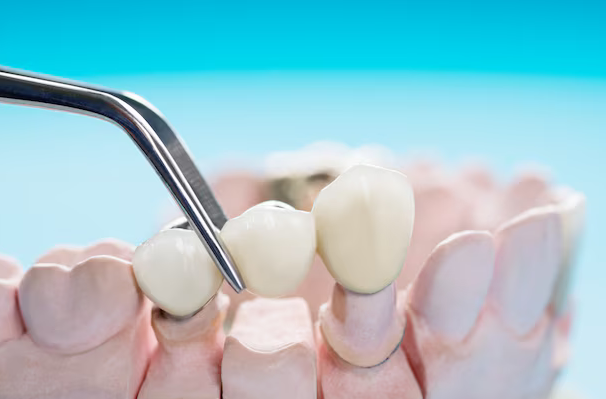 dental bridges madison al