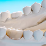 dental crowns athens al