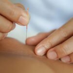 dry needling physiotherapy