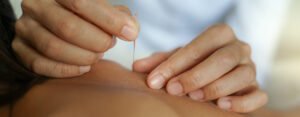 dry needling physiotherapy
