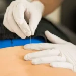 Dry Needling for Back Pain