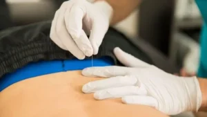 Dry Needling for Back Pain