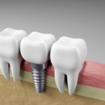 single tooth implant glendale az