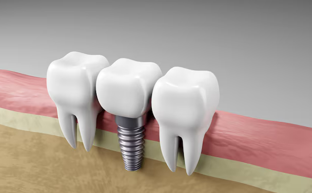 single tooth implant glendale az