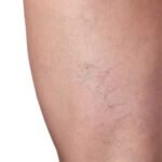 Spider Veins Treatment In Dubai